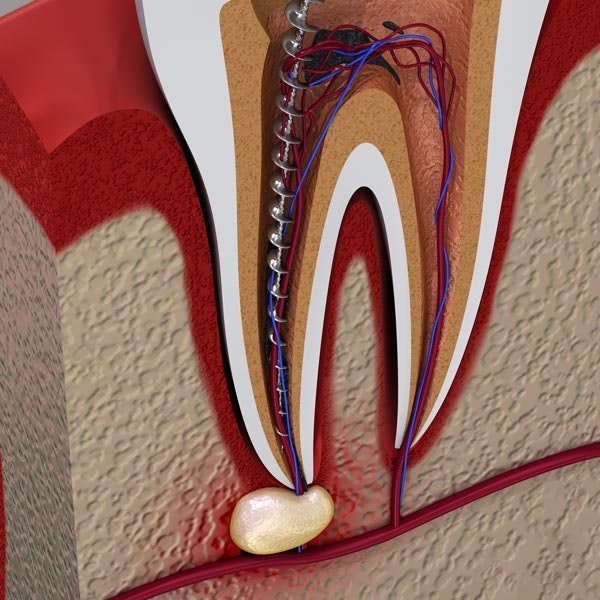 Illustration of root canal procedure