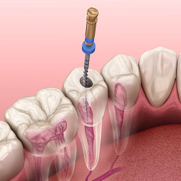 Root canal procedure