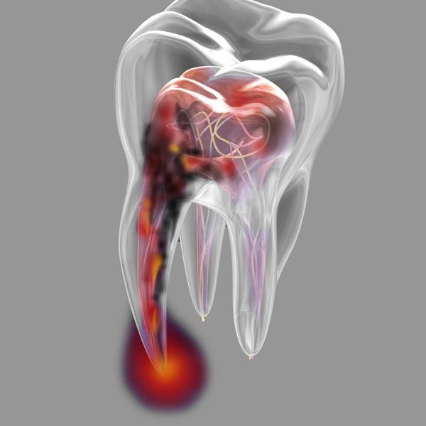 Illustration of tooth with bacteria