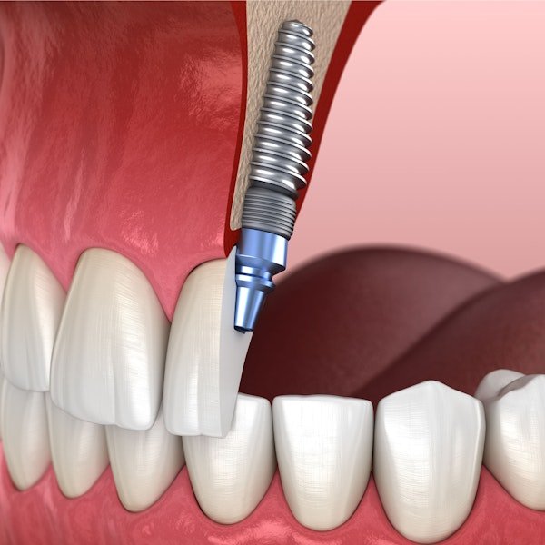 Dental implants